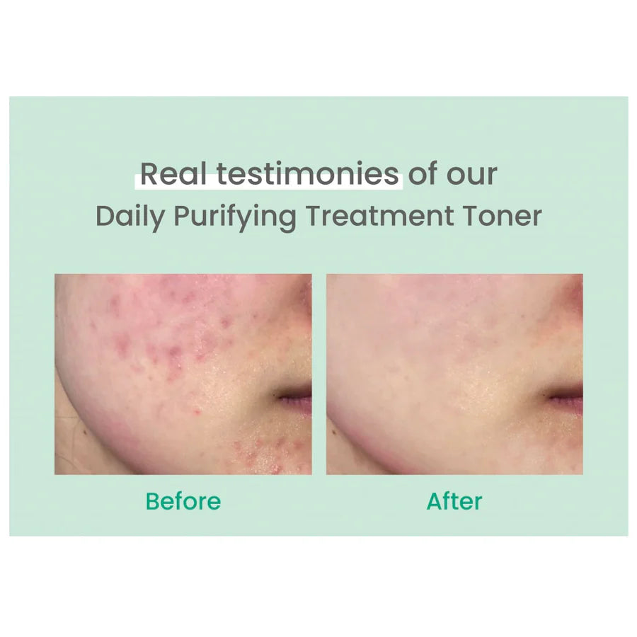 Before and after close-up of skin showing improved acne after using AXIS-Y daily purifying toner