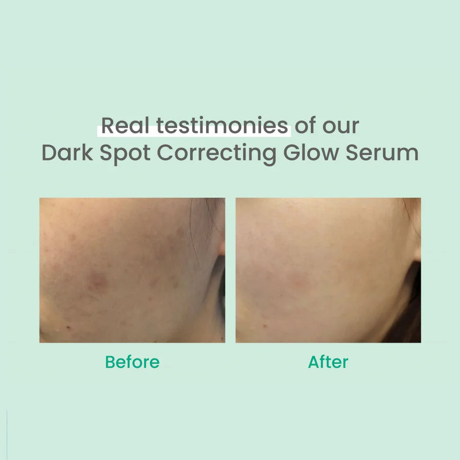 Before and after images showing skin improvement using Zuzu Aura Dark Spot Correcting Glow Serum from Korean skincare bundle deal