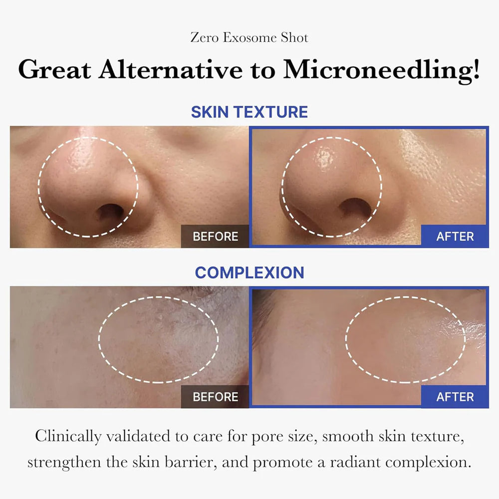 Medicube exosome pore ampoule before and after images showing improved skin texture and complexion