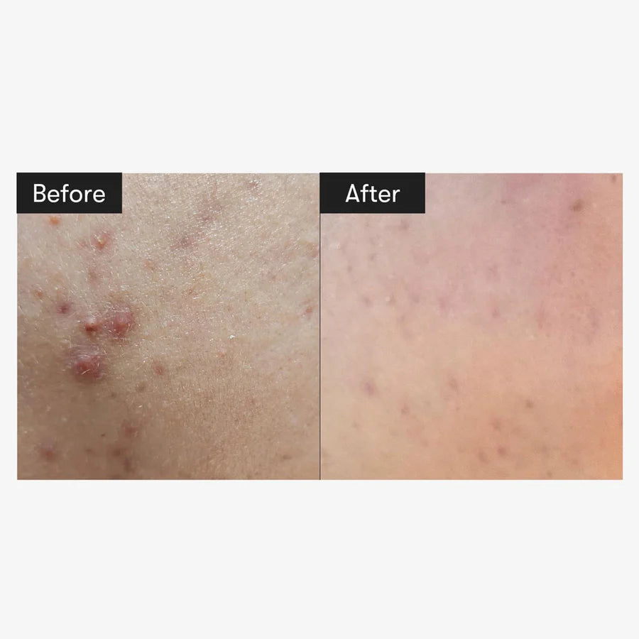 Before and after close-up showing smooth skin improvement using Reedle Shot 100 serum by VT Cosmetics