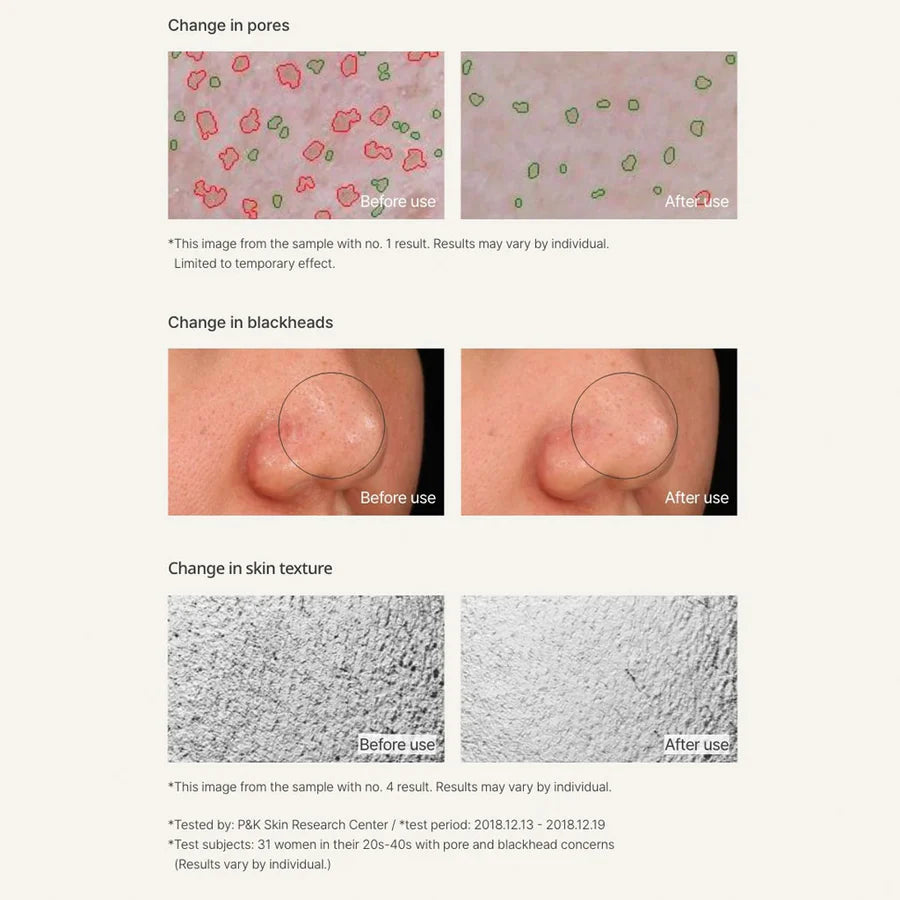 Before and after results of innisfree clay mask showing reduced pores, fewer blackheads, and improved skin texture, best clay mask for oily skin