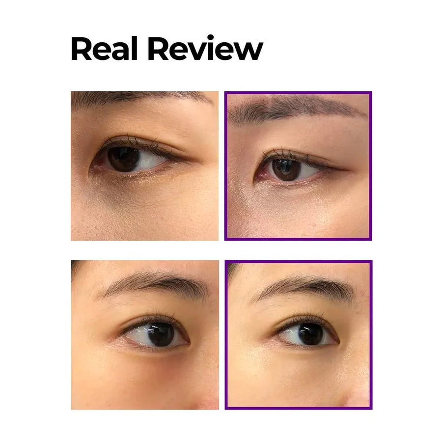 Before and after close-up images showing effectiveness of retinol eye cream for dark circles by Some By Mi