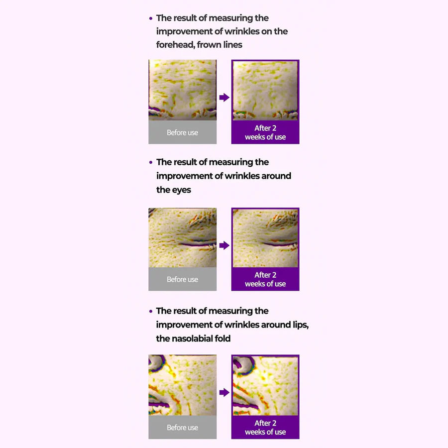 Before and after images showing wrinkle improvement after 2 weeks of using retinol eye cream for dark circles